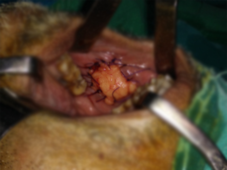 Cancer Of Buccal Mucosa